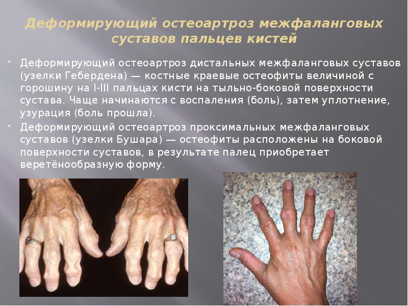 Деформирующий остеоартроз межфаланговых суставов пальцев кистей Деформирующий остеоартроз дистальных межфаланговых суставов