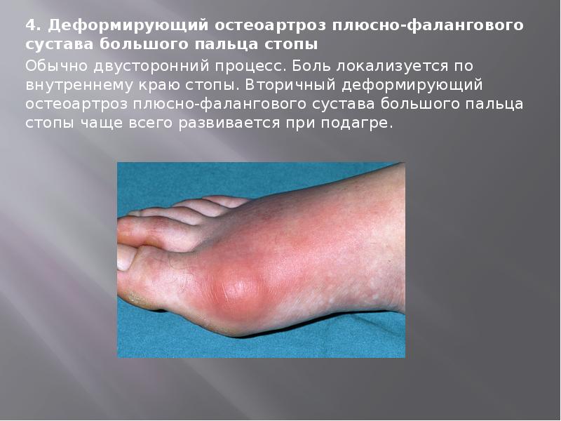 4. Деформирующий остеоартроз плюсно-фалангового сустава большого пальца стопы Обычно двусторонний процесс.
