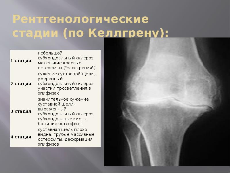 Диагноз доа суставов. Асептический некроз коленного сустава рентген. Деформирующий артроз рентген. Деформирующий артроз 1-2 степени. Остеоартроз коленного сустава степени рентген.