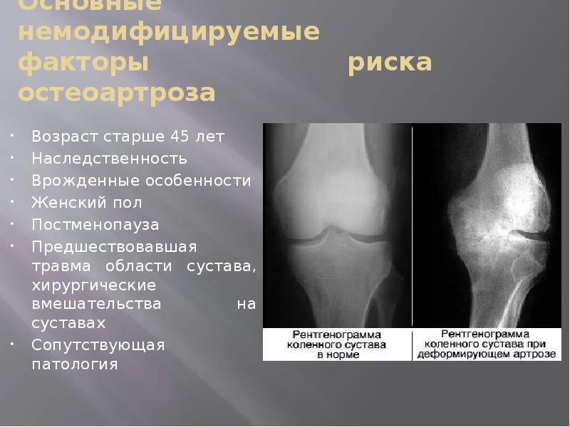 Основные немодифицируемые факторы риска остеоартроза Возраст старше 45 лет Наследственность 