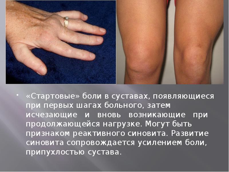 «Стартовые» боли в суставах, появляющиеся при первых шагах больного, затем исчезающие&nbsp;&nbsp;