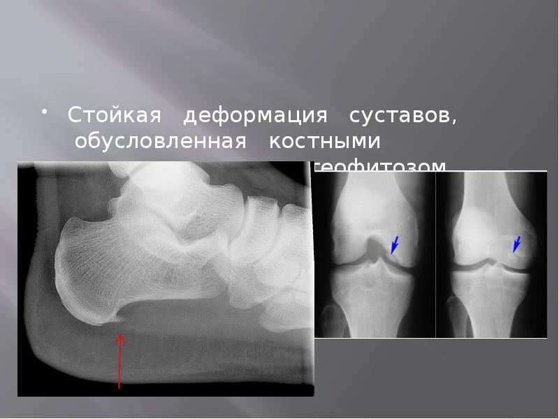 Стойкая&nbsp;&nbsp; деформация&nbsp;&nbsp; суставов, &nbsp;обусловленная&nbsp;&nbsp; костными изменениями, т.е. остеофитозом