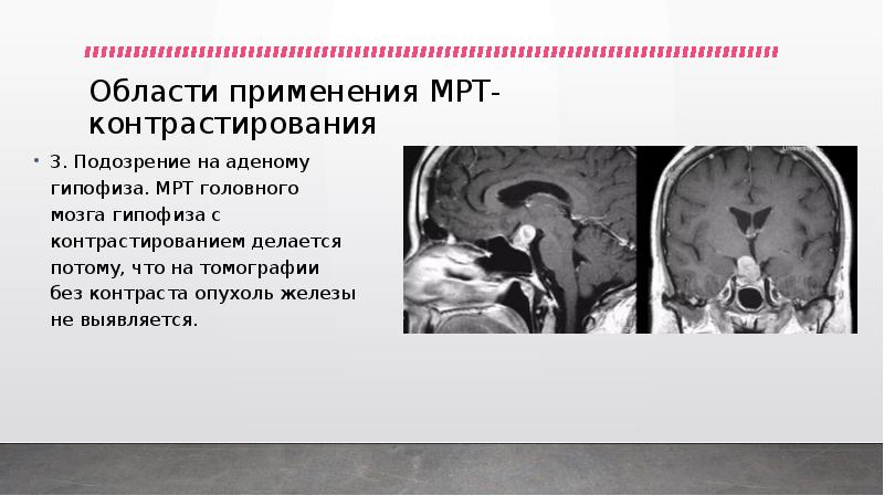 Мрт гипофиза ростов. Мрт головы аденома гипофиза. MRT головного мозга гипофиз.