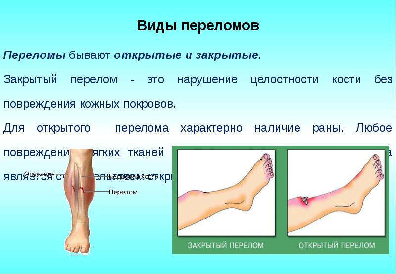 Переломы виды переломов первая помощь презентация