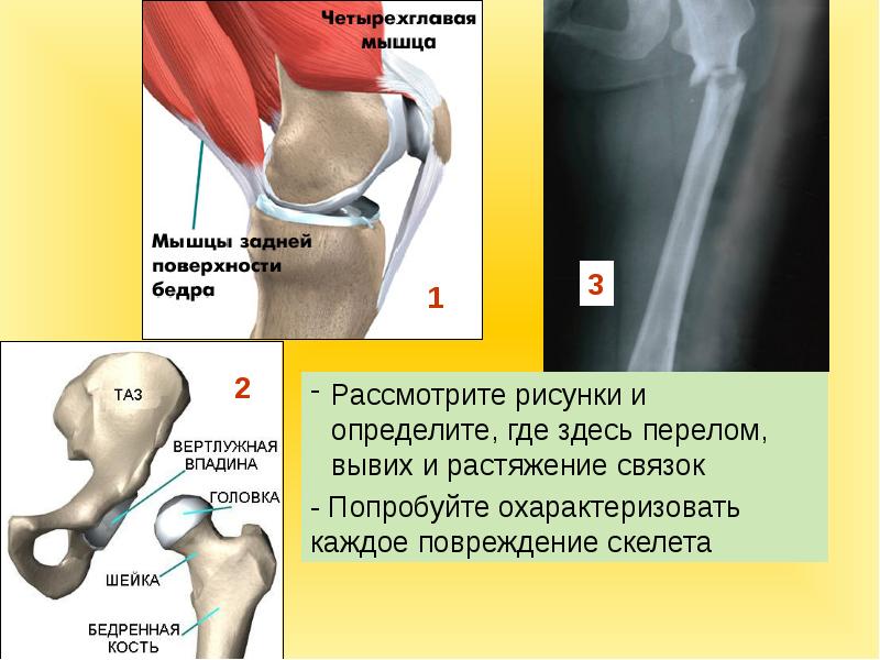 Какой вид травмы скелета изображен на рисунке