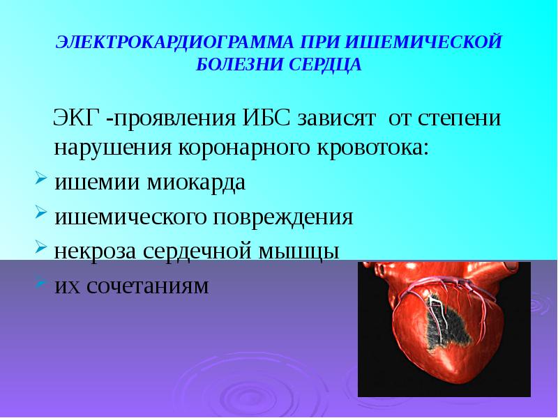Критерии ишемии. ЭКГ при ишемической болезни сердца. Электрокардиограмма при ишемической болезни сердца. Ишемические заболевания сердца презентация.