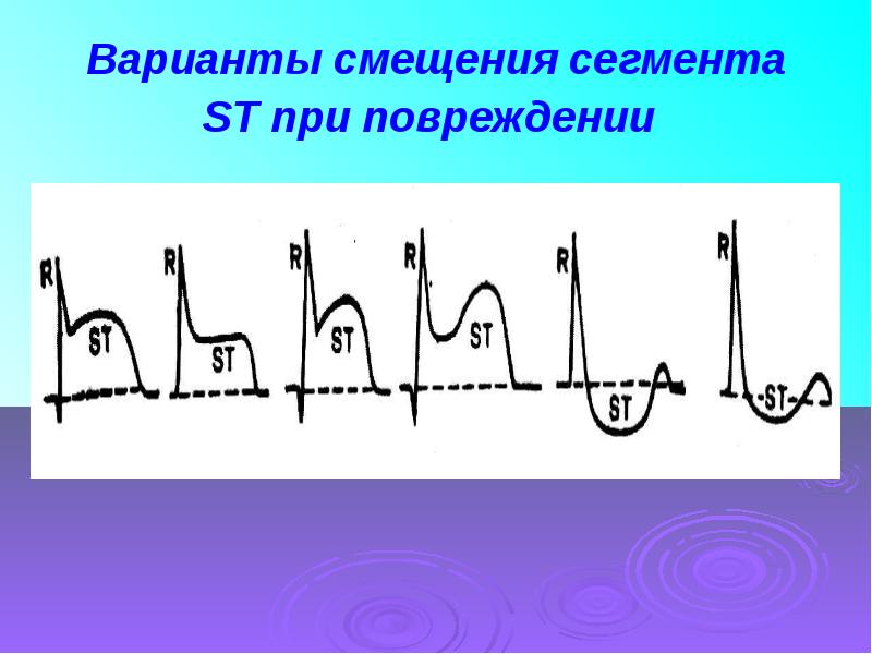 Сегмент st на экг. Корытообразный сегмент St на ЭКГ. ЭКГ корытообразное St. Смещение сегмента St на ЭКГ. Смещение сегментов ЭКГ.