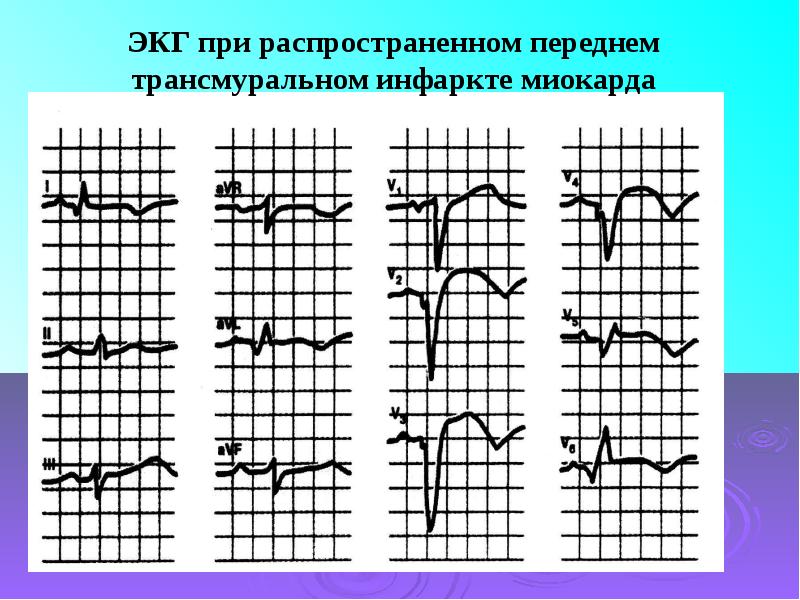 Трансмуральный инфаркт. Трансмуральная ишемия передней стенки ЭКГ. ЭКГ при трансмуральном инфаркте. Трансмуральный инфаркт на ЭКГ. Трансмуральный инфаркт миокарда на ЭКГ.