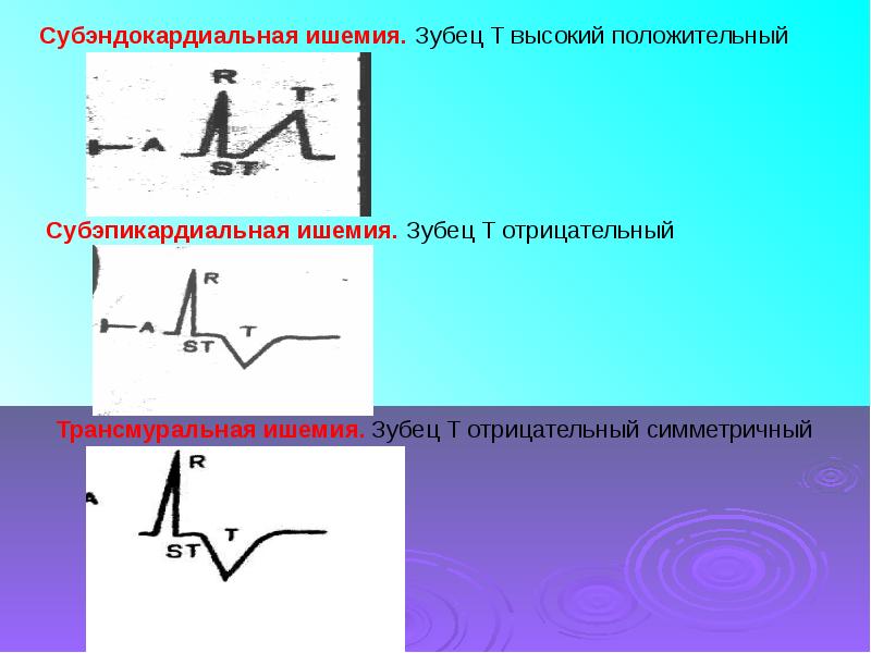 Субэндокардиальная ишемия боковой стенки