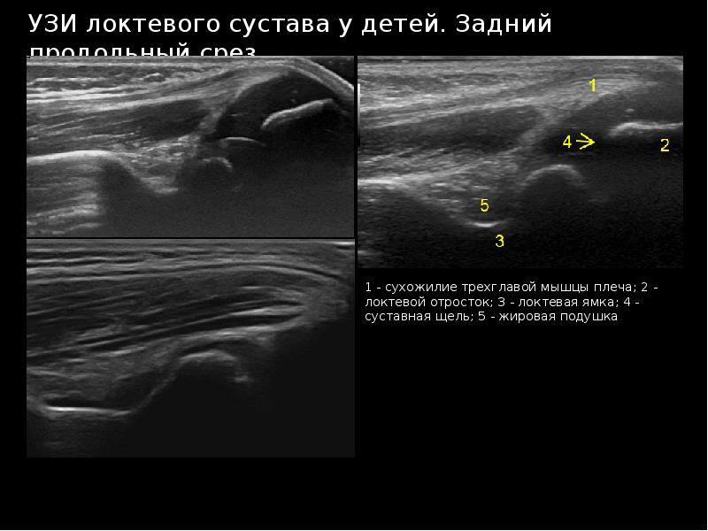 Узи суставов. Эпикондилит локтевого сустава на УЗИ протокол. Локтевой сустав УЗИ Диагностер. Бурсит локтевого на УЗИ протокол. Бурсит локтевого сустава УЗИ описание.