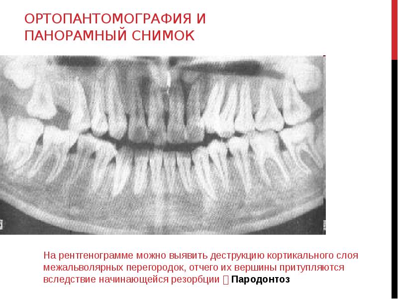 Расшифровка рентгена зубов с примерами и фото