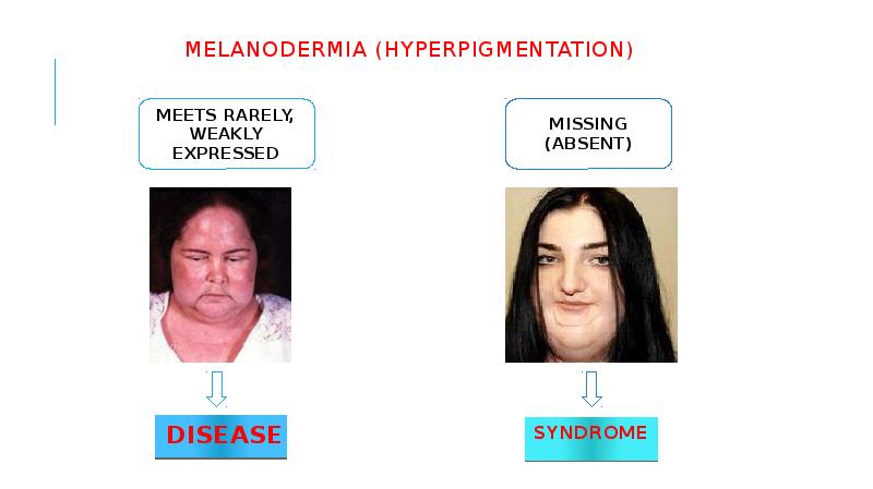 MELANODERMIA (HYPERPIGMENTATION) DISEASE