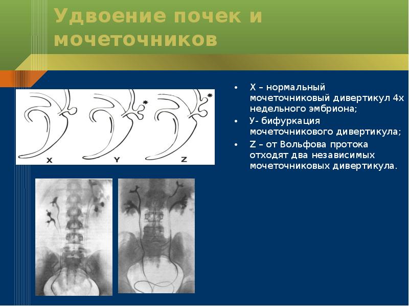 Аномалии мочеточников презентация