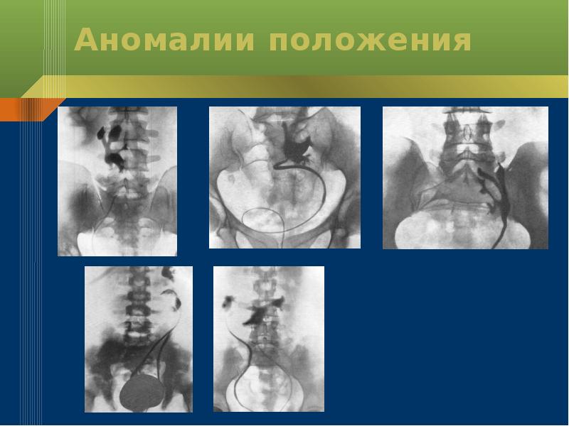 Аномалии почек презентация