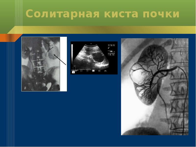 Аномалии почек презентация