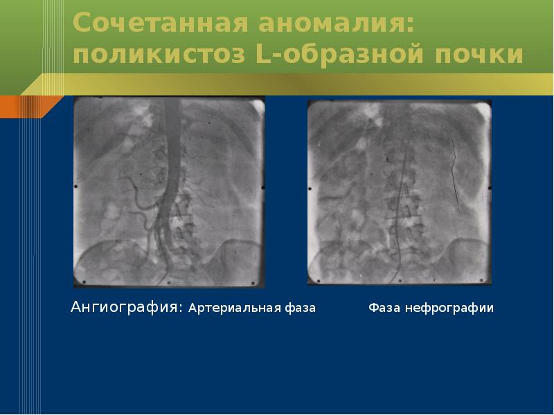 Аномалии почек презентация