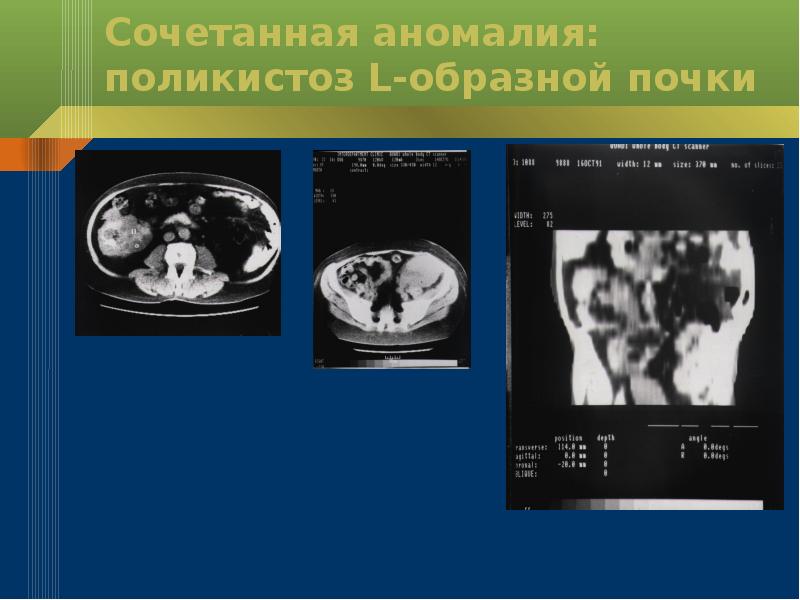 Аномалии почек презентация