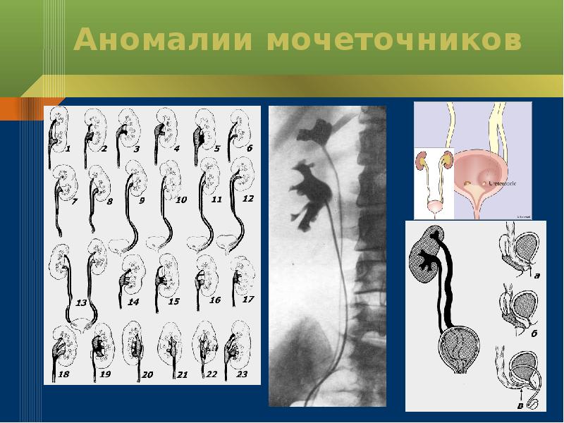 Аномалии почек презентация