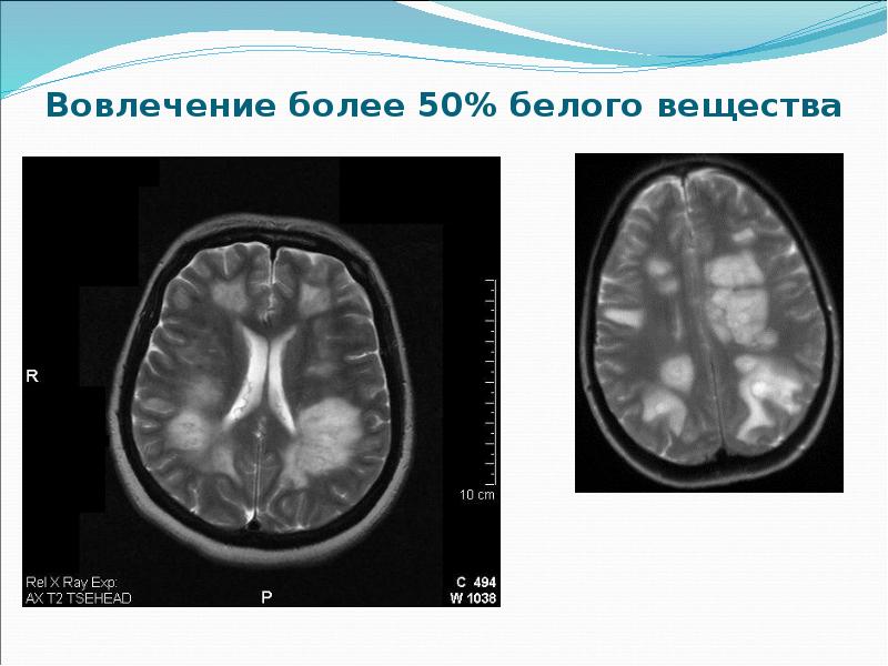 Острый рассеянный энцефаломиелит презентация