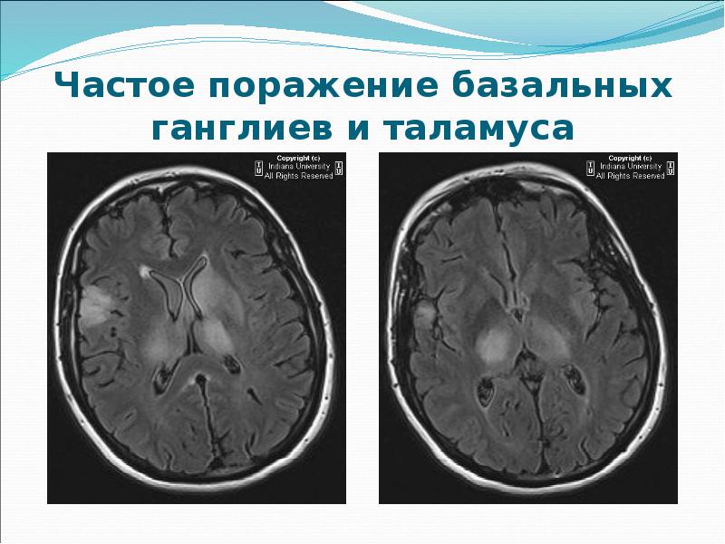 Острый рассеянный энцефаломиелит презентация