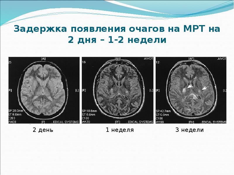 Острый рассеянный энцефаломиелит презентация