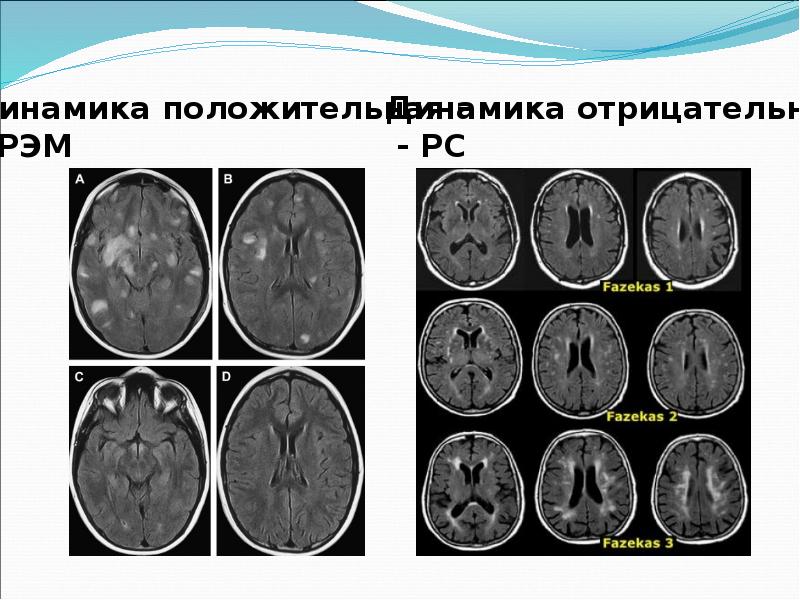 Острый рассеянный энцефаломиелит презентация