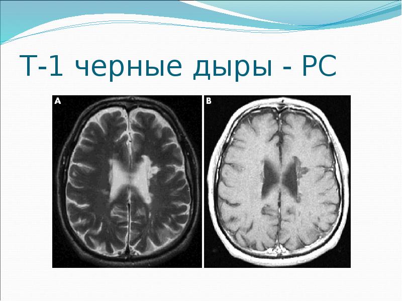 Острый рассеянный энцефаломиелит презентация