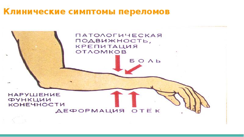 Перелом кости симптомы. Основные симптомы перелома костей конечностей. Клинические симптомы переломов. Клинические проявления перелома кости.