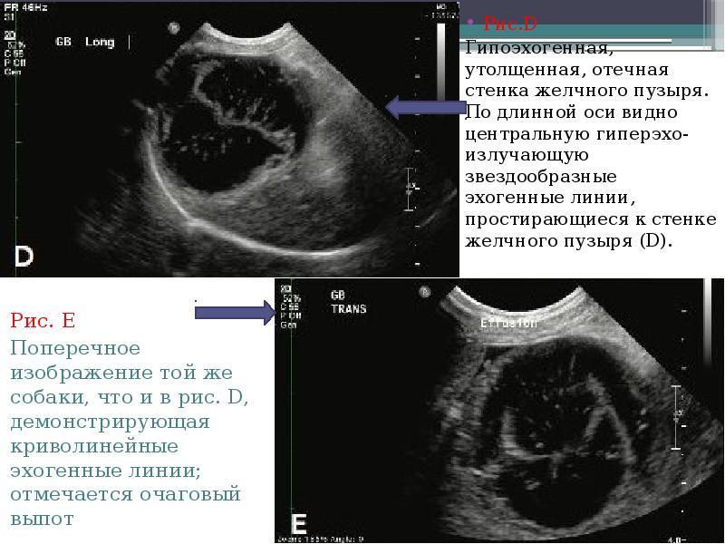 Уплотненная стенка желчного пузыря. Утолщенные стенки в желчном. Стенки желчного пузыря утолщены. Стенка желчного пузыря утолщена. Эхогенная линия.