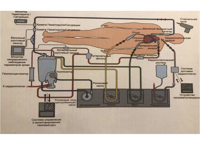 Схема системы экстракорпорального кровообращения