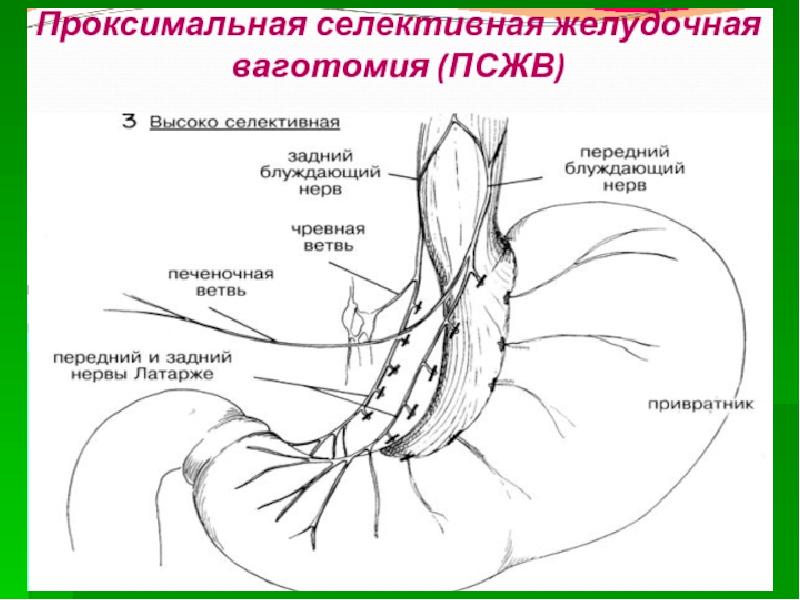 Болезни оперированного желудка рекомендации. Болезни оперированного желудка презентация. Синдром оперированного желудка презентация. Ререзекция оперированного желудка. Синдром оперированного желудка.