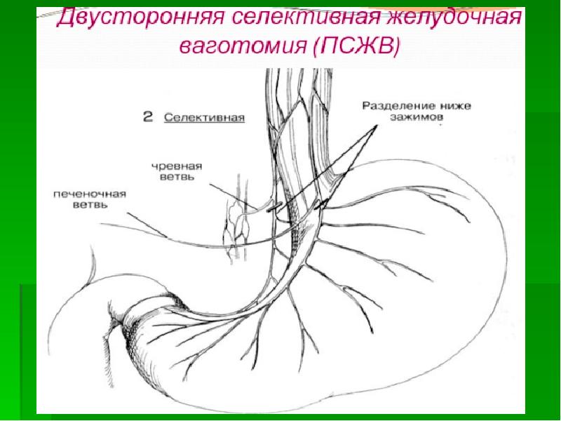 Болезни оперированного желудка презентация