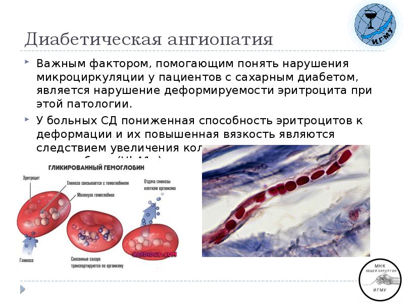 Диабетическая микроангиопатия. Диабетическая микроангиопатия атеросклероз. Диабетическая ангиопатия патанатомия. Диабетическая ангиопатия стопы симптомы. Диабетическая миопатия.