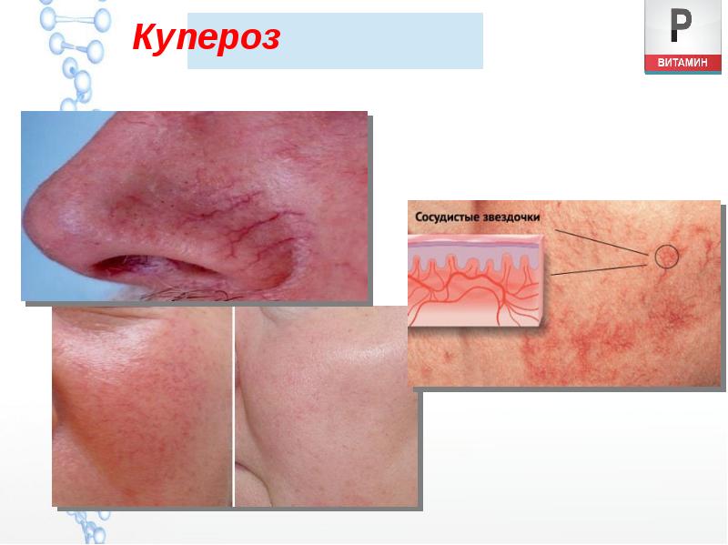 Купероз Купероз
