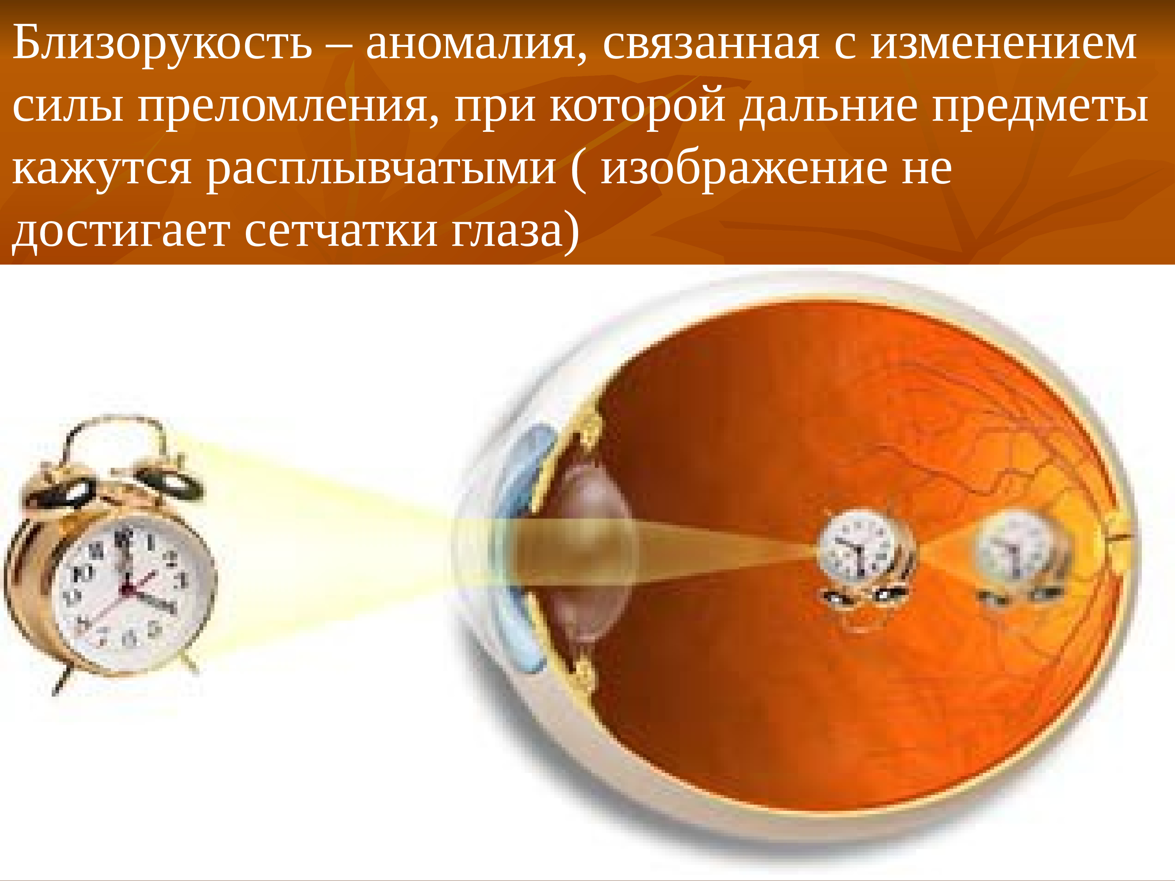 Расплывчатое изображение далеко расположенных предметов является признаком