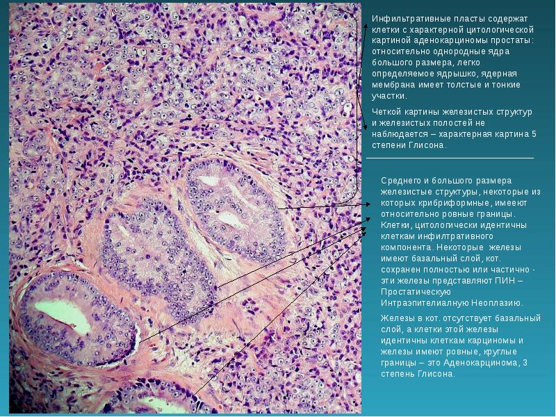 Аденокарцинома предстательной железы. Аденокарцинома предстательной железы гистология. Аденокарцинома предстательной железы микропрепарат. Аденокарцинома предстательной железы гистология описание. Аденокарцинома предстательной железы микро.