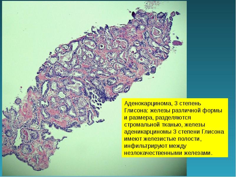 Ацинарная аденокарцинома предстательной глисон 3 3. Ацинарная аденокарцинома простаты микропрепарат. Ацинарная аденокарцинома микропрепарат. Аденокарцинома предстательной железы микропрепарат. Ацинарная аденокарцинома предстательной железы.