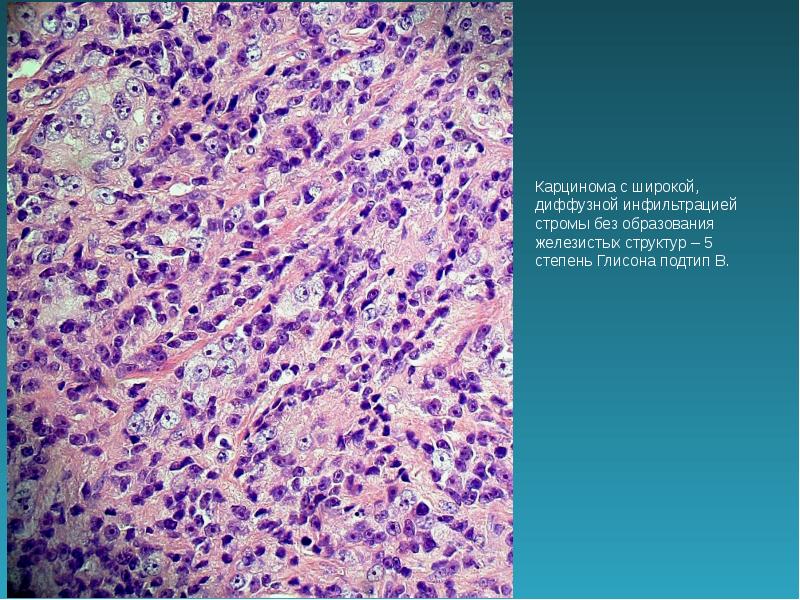 инфильтрация стромы. лимфоидная инфильтрация гистология. хронический тиреоидит гистология. лимфогистиоцитарная воспалительная инфильтрация. слабая лимфогистиоцитарная инфильтрация.