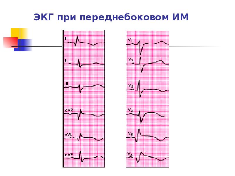 Болезни на экг. Переднебоковой инфаркт на ЭКГ. Субэндокардиальная ишемия на ЭКГ. Ишемия переднебоковой стенки на ЭКГ. Заболевания сердца на ЭКГ.