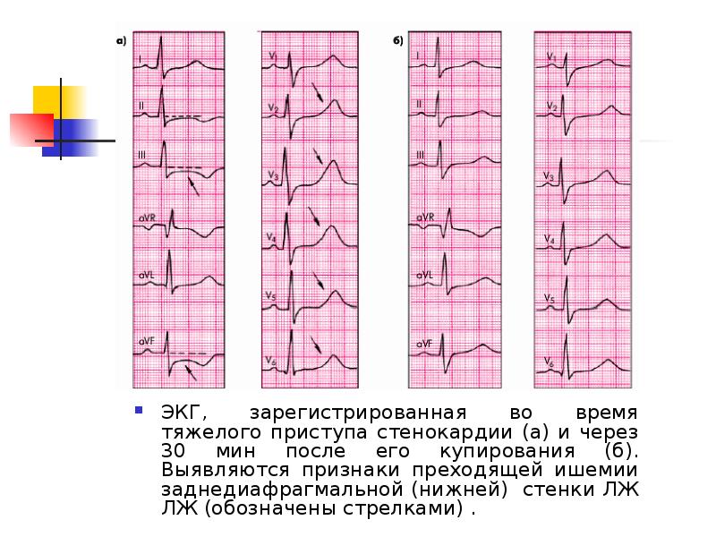 Нижняя стенка лж