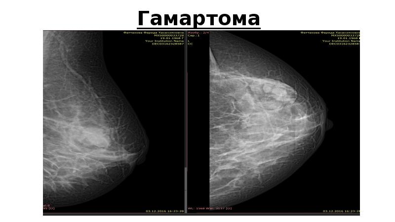 Какое ультразвуковая картина наиболее характерна для гамартомы молочной железы