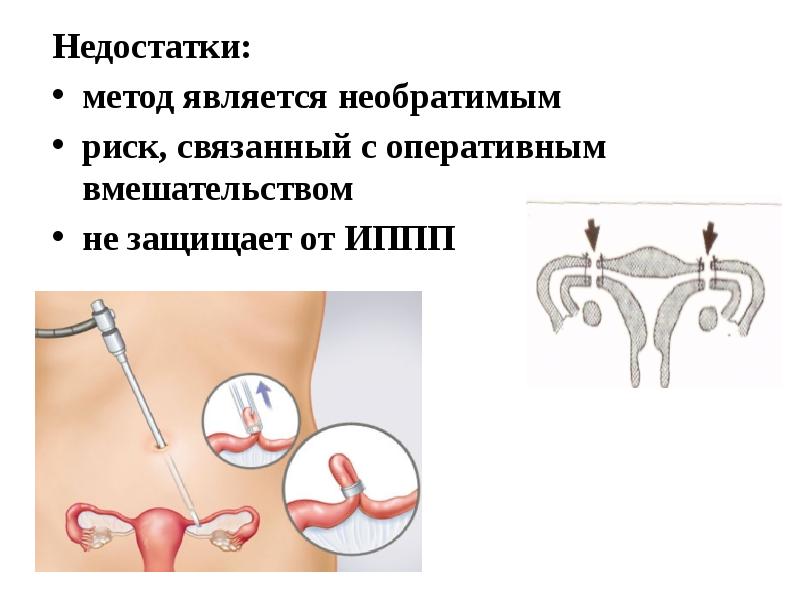 Планирование семьи гинекология презентация