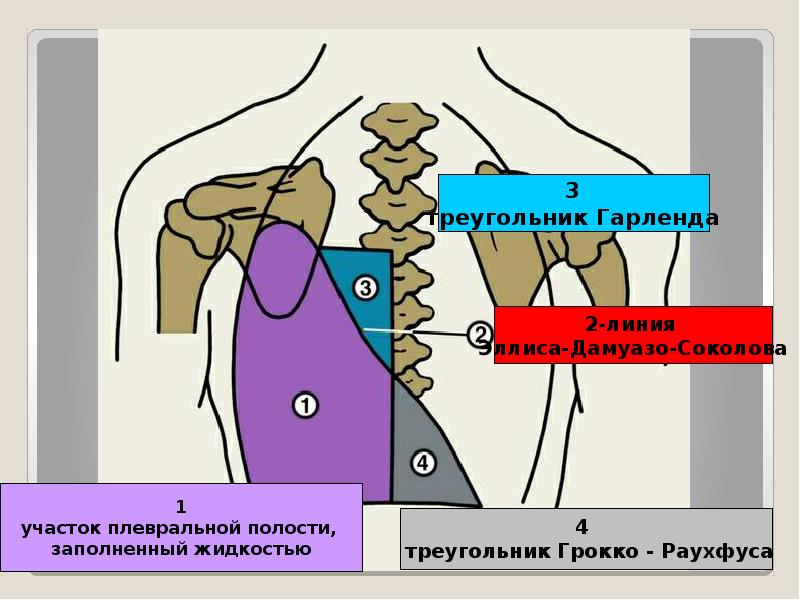 Какая аускультативная картина характерна для сухого плеврита