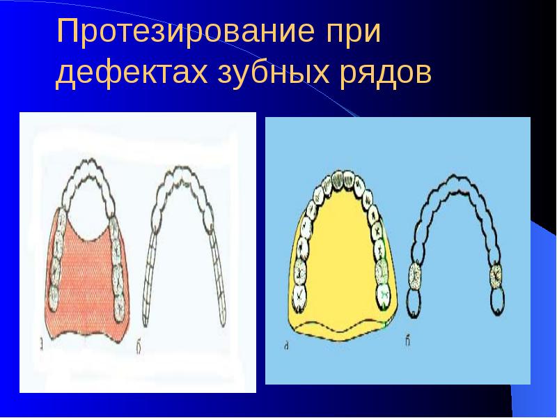 Обследование пациентов с обширными дефектами зубных рядов презентация