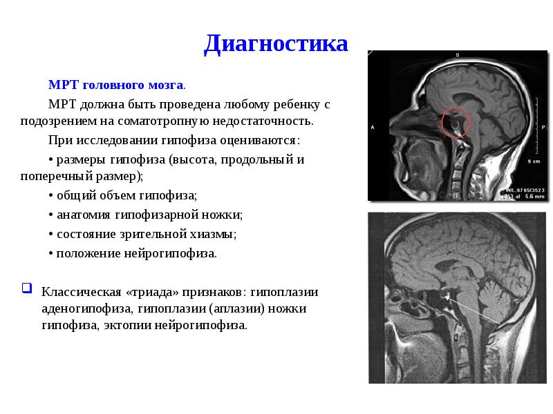 Мр картина диффузно неоднородной структуры гипофиза