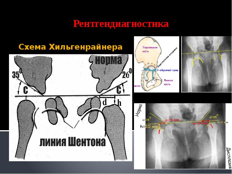 Вывих бедра презентация