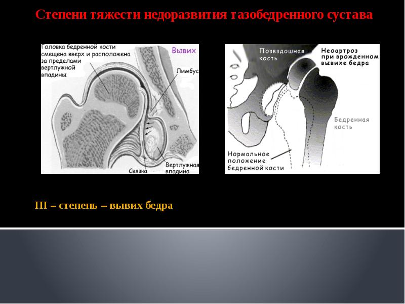 Врожденные вывихи бедра презентация