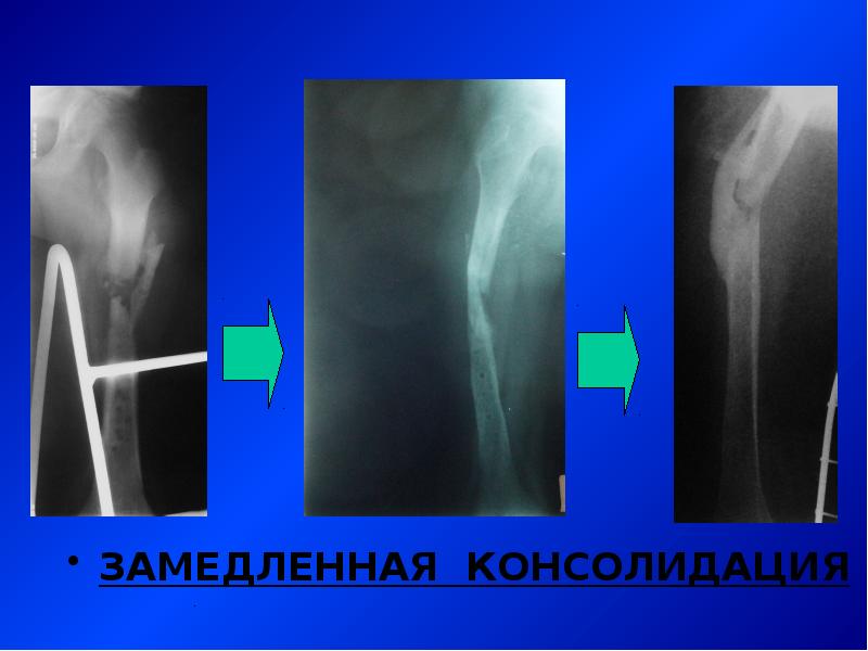 Консолидация перелома. Замедленная консолидация переломов и ложные суставы. Замедленная консолидация переломов рентген. Замедленная консолидация и ложный сустав. Замедленная консолидация отломков.