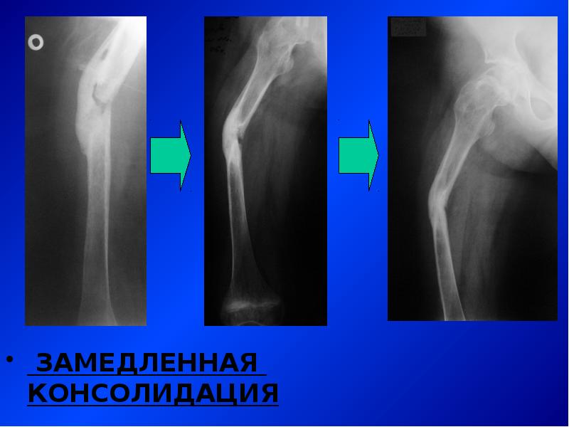 Консолидация перелома. Замедленная консолидация переломов и ложные суставы. Стадии консолидации перелома на рентгене. Замедленная консолидация переломов рентген. Замедленной консолидации отломков.