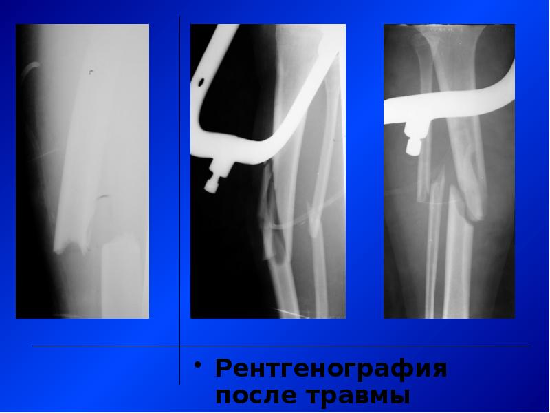 Внеочаговый остеосинтез презентация